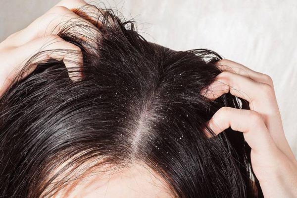 Dandruff leads to scalp inflammation, itching and shedding